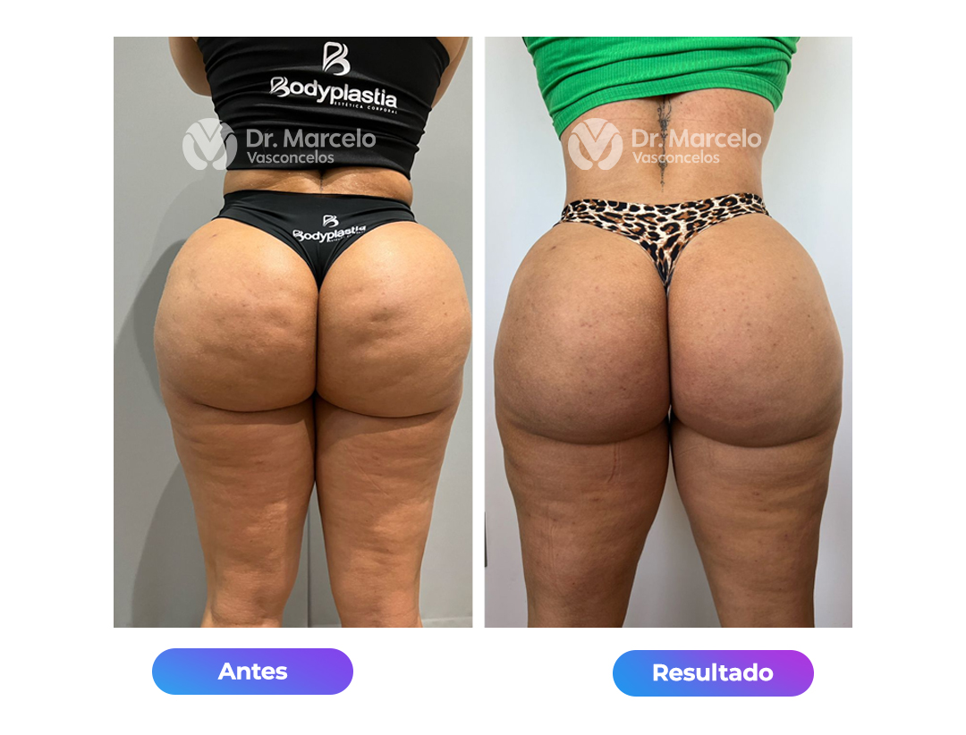 Celulites--Dr-Marcelo-Vasconcelos-3